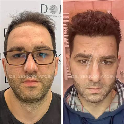 serkan aygin reviews|Dr. Serkan Aygin Hair Transplant Clinic Reviews .